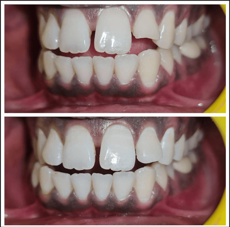Before & After Teeth Adjustment