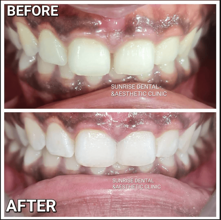 Before & After Cavities Cleaning