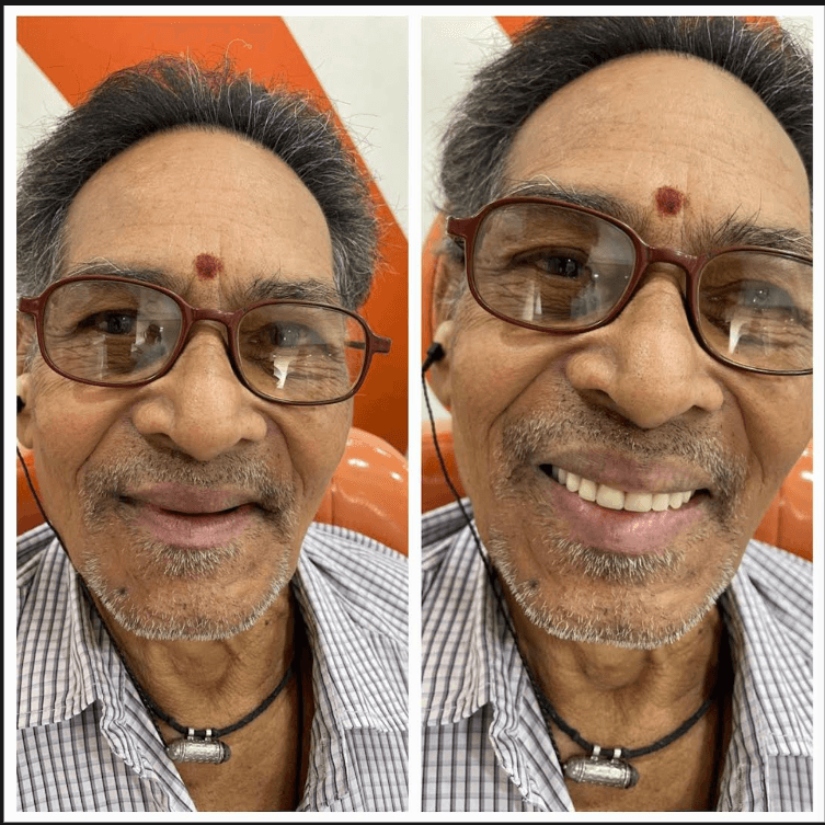 Complete Denture Transformation