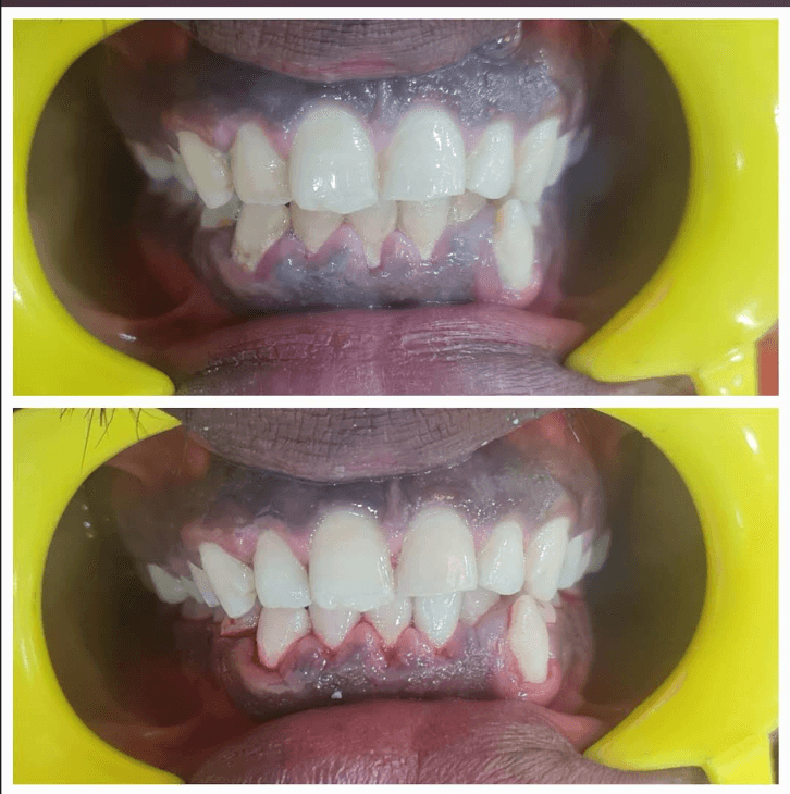 Teeth Cleaning